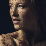 Herpes i lëkurës: Çfarë është?